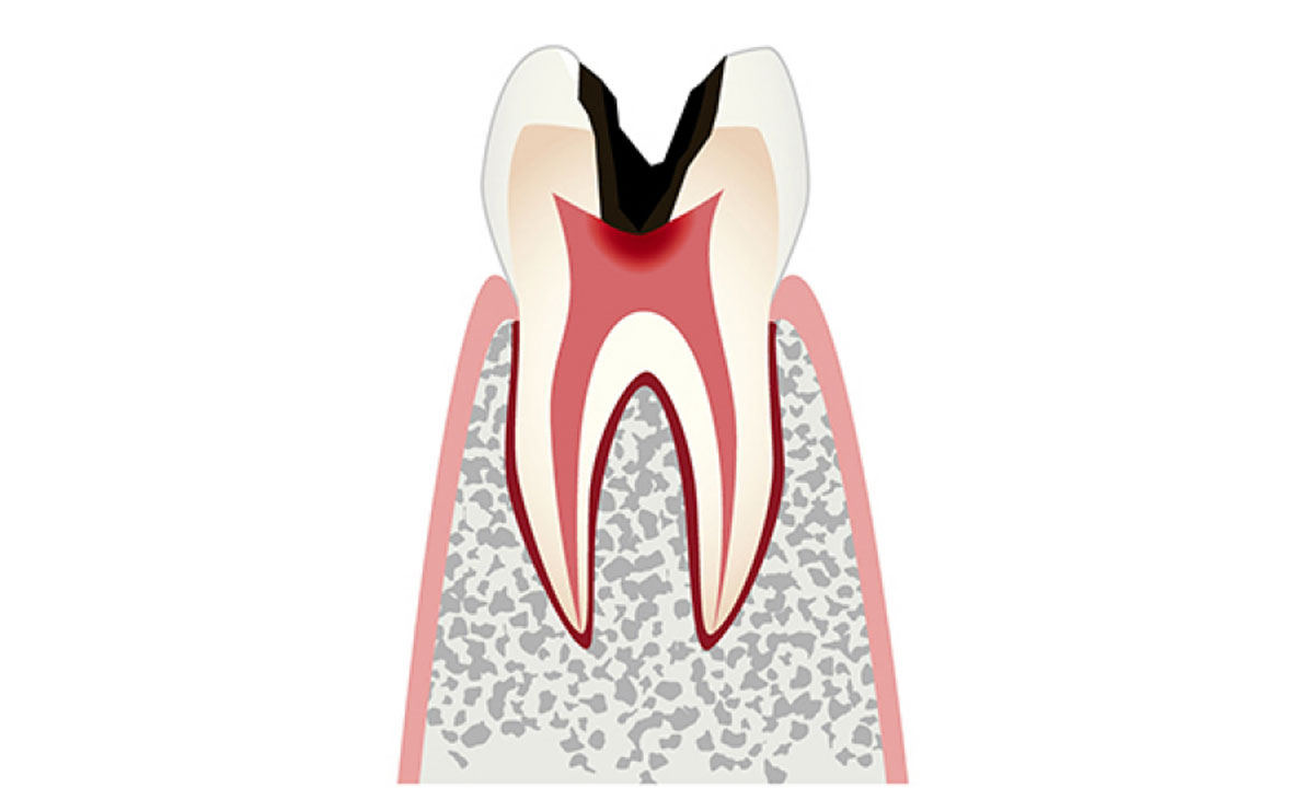 C3 重度の虫歯